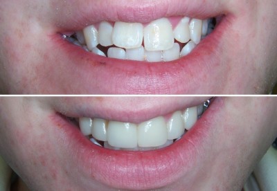 orthosnap teeth straightening without braces