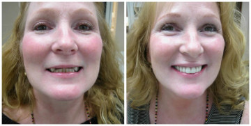 Cosmetic dentist Brooklyn NY | Best cosmetic dentist Brooklyn NY | smile makeover Brooklyn NY