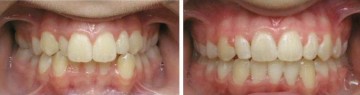 cosmetic dentist Brooklyn NY | straighten teeth without braces Brooklyn NY