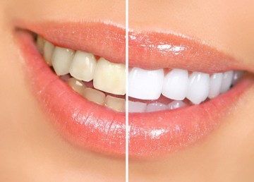 cosmetic dentist brooklyn ny | teeth whitening Brooklyn NY